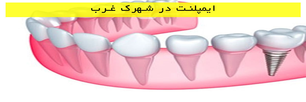 ایمپلنت-در-شهرک-غرب ایمپلنت در شهرک غرب