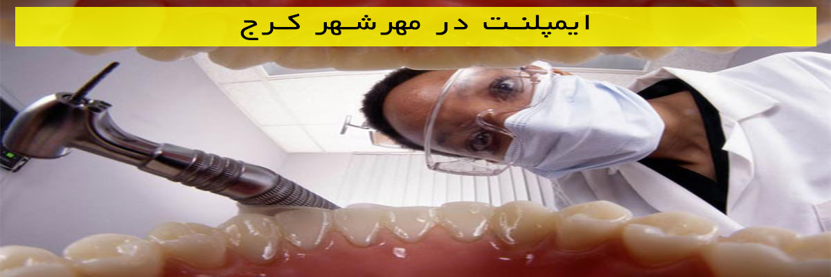 ایمپلنت در مهرشهر کرج