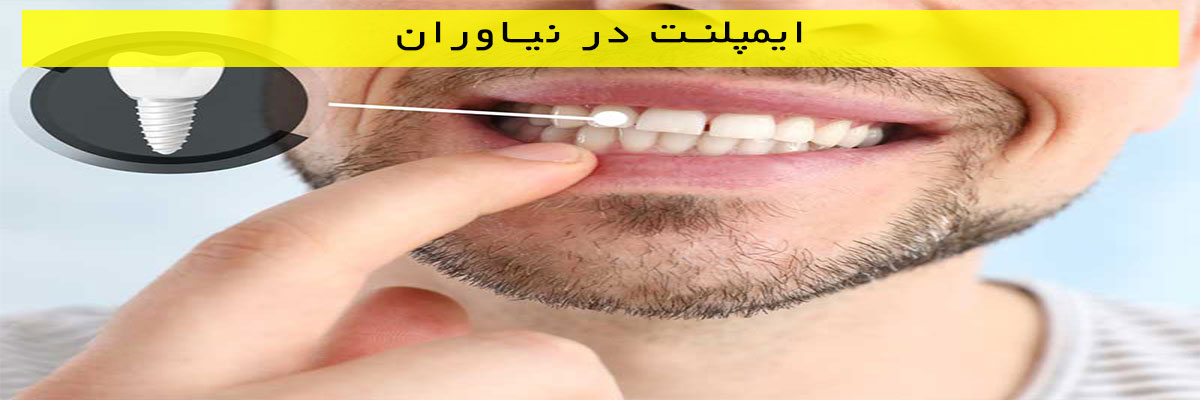 ایمپلنت-در-نیاوران ایمپلنت در نیاوران
