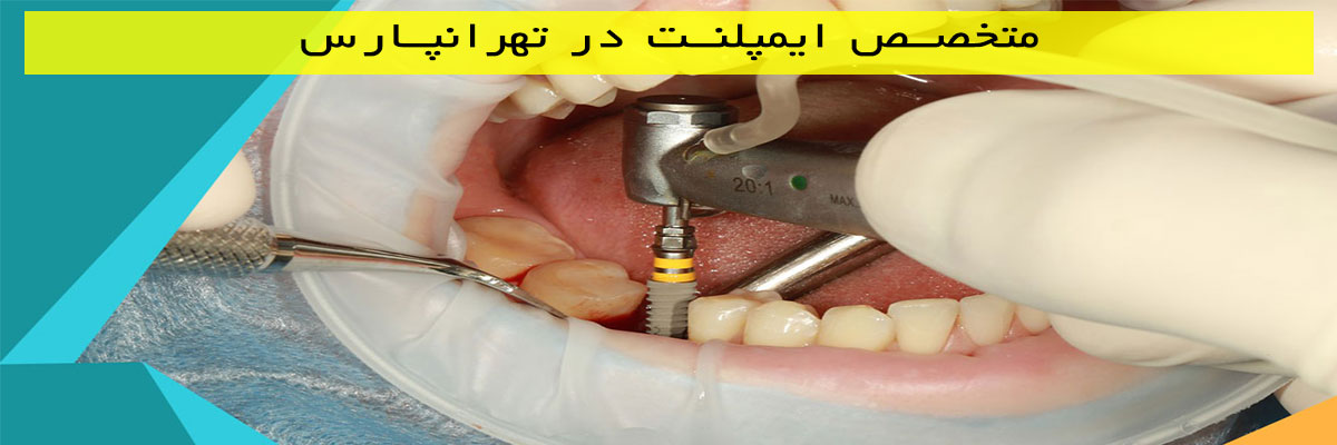 متخصص-ایمپلنت-در-تهرانپارس متخصص ایمپلنت در تهرانپارس