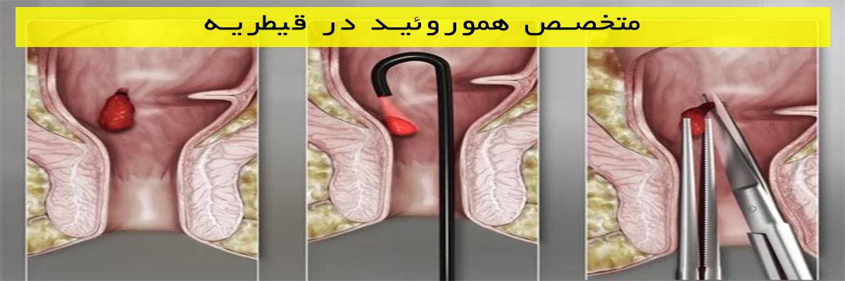 متخصص-هموروئید-در-قیطریه متخصص هموروئید در قیطریه