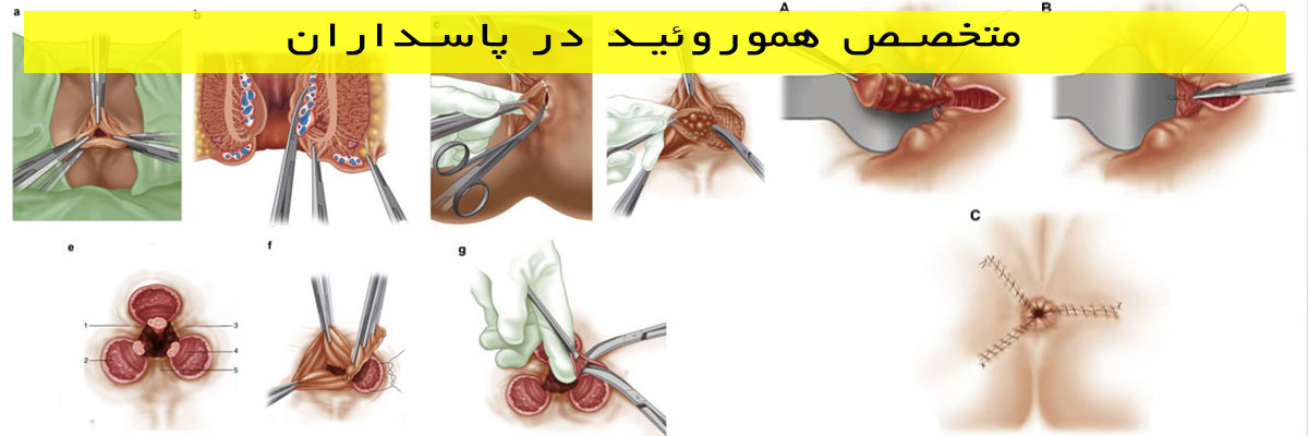 متخصص-هموروئید-در-پاسداران متخصص هموروئید در پاسداران