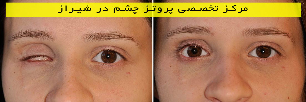 مرکز-تخصصی-پروتز-چشم-در-شیراز مرکز تخصصی پروتز چشم در شیراز