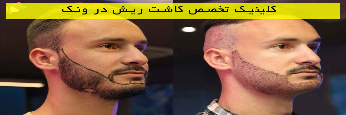 کلینیک-تخصص-کاشت-ریش-در-ونک کلینیک تخصص کاشت ریش در ونک
