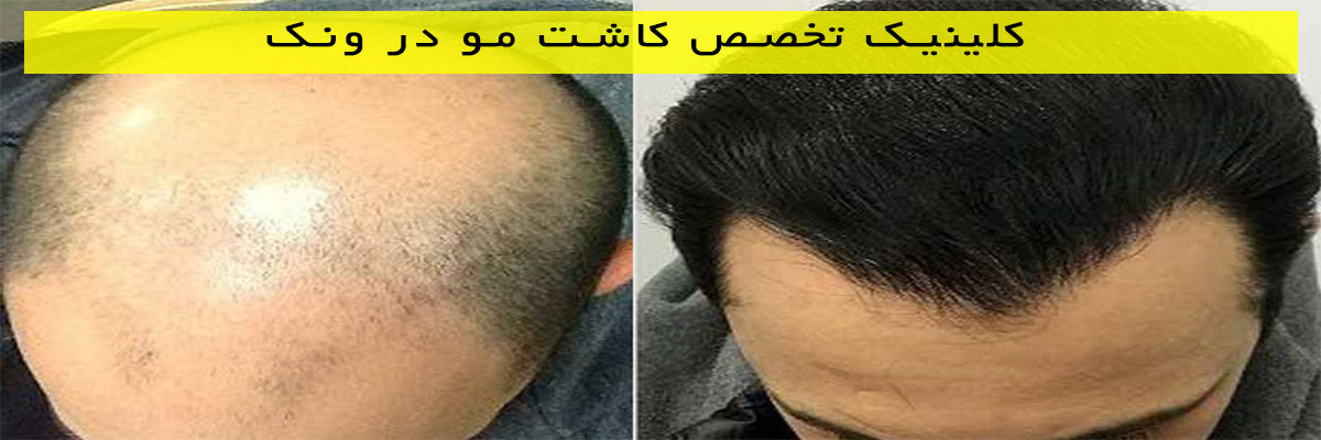 کلینیک-تخصص-کاشت-مو-در-ونک کلینیک تخصص کاشت مو در ونک