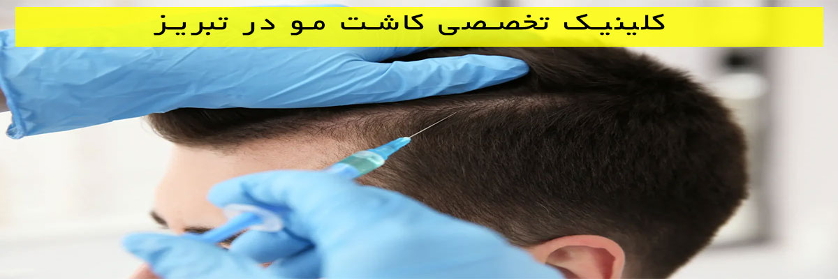 کلینیک-تخصصی-کاشت-مو-در-تبریز کلینیک تخصصی کاشت مو در تبریز